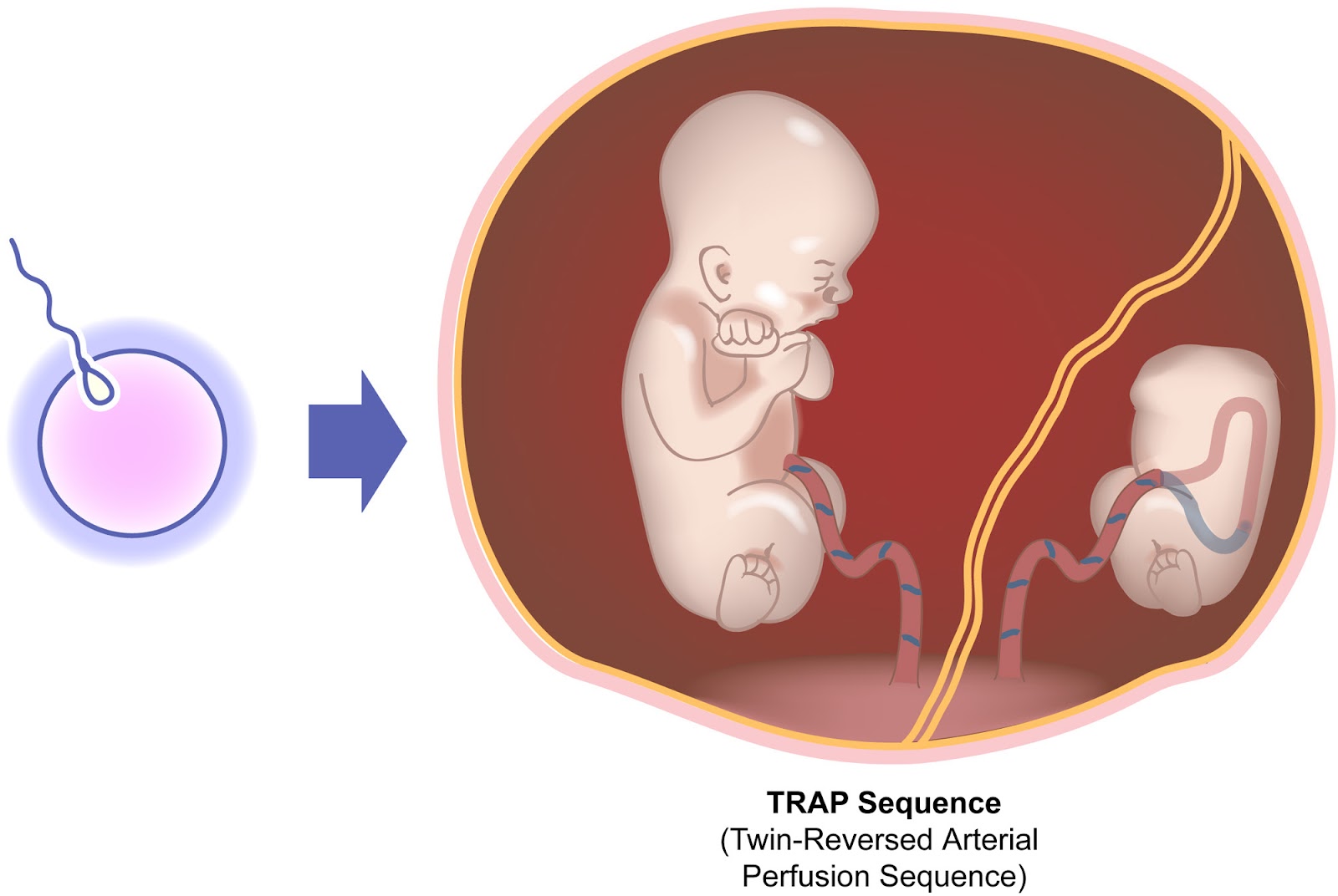 Si kembar 3 twin to twin transfusion syndrome